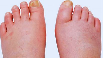 Himachal Common swelling may be cancer in 77 percent of the cases the initial diagnosis by doctors was wrong