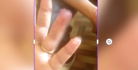 Woman bites neighbour finger in dispute over children in bhadohi