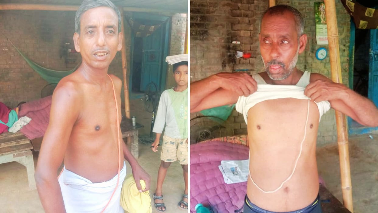 Life in danger Arsenic dissolved in veins of many lakh people of 315 villages of Ballia skin disease problem