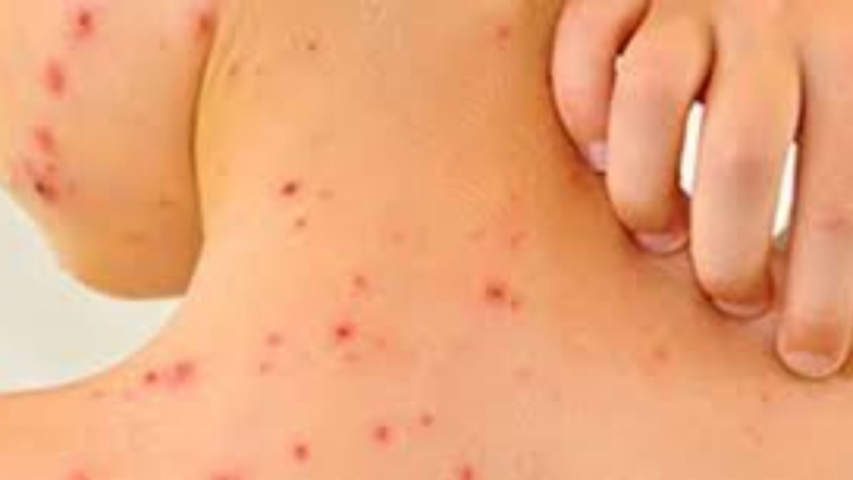 WHO team will collect samples after chickenpox symptoms found in six-year-old girl in Varanasi