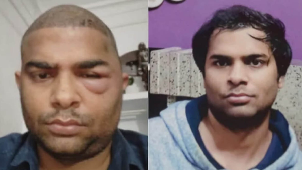 Kanpur: Another engineer dies after getting a hair transplant