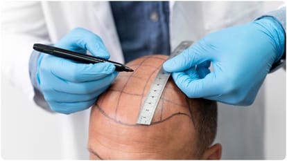 hair transplant is safe or not know Complications and precautions of Transplantation