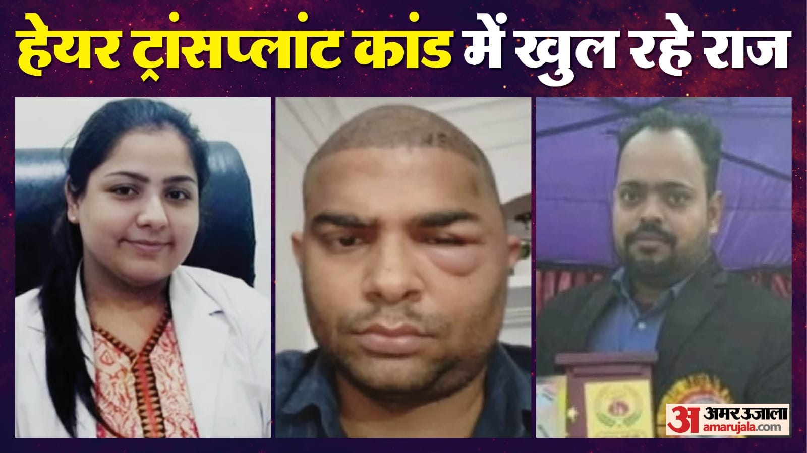 Kanpur hair transplant case Call details revealed Engineers used to talk to Dr Anushka