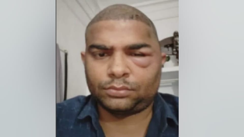 Kanpur Hair Transplant case Swelling in head face blue blood sugar 350 New revelation in post-mortem report