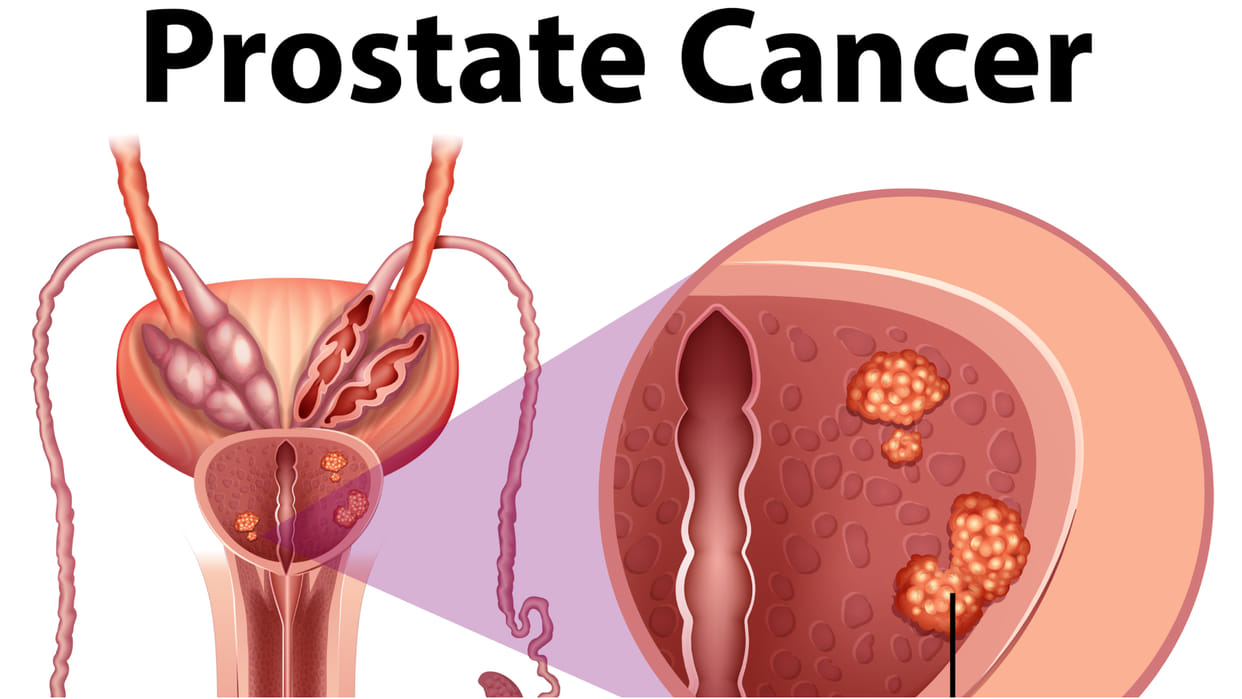 prostate cancer causes symptoms and treatment know prostate cancer ka karan kya hai