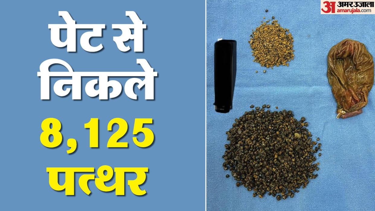 8125 stones removed from gall bladder of a 70-year-old patient in delhi