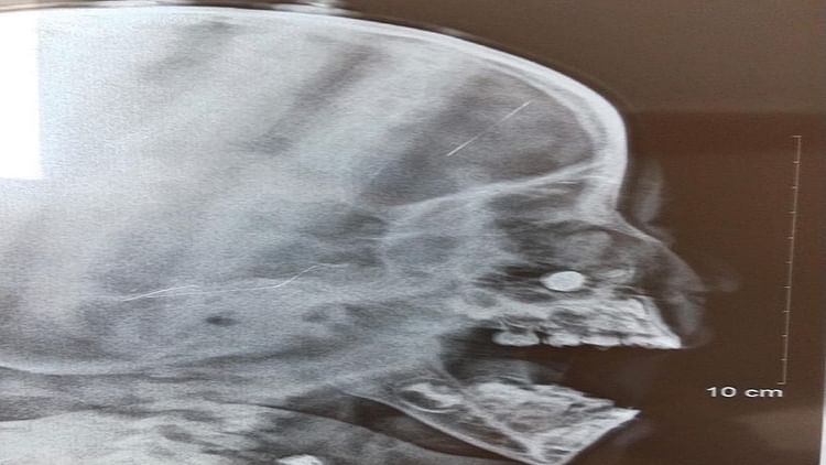 Delhi : पांच साल के बच्चे की नाक में फंसी खिलौने की बैटरी, डॉक्टरों ने बचाई जान; टल गया खतरा