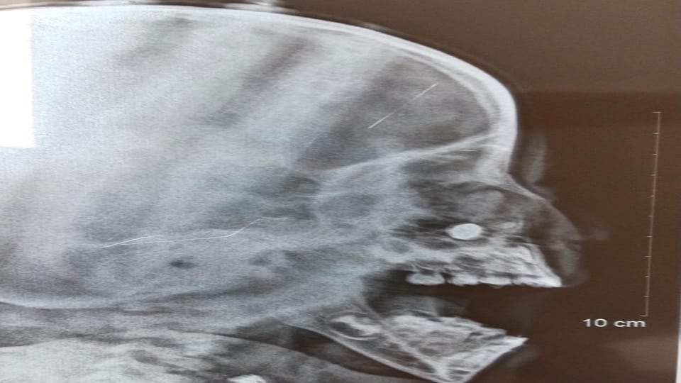 Delhi: Toy battery stuck in the nose of a five-year-old child, doctors saved his life