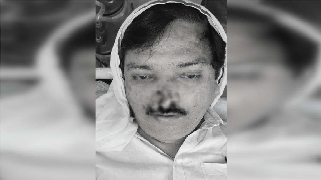 Society secretary s nose was bitten off in Kanpur in a parking dispute