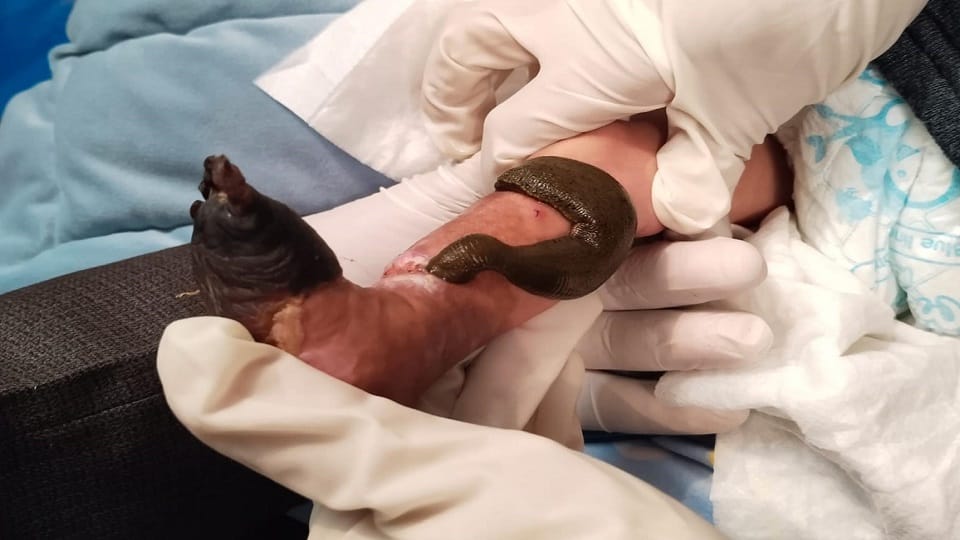 psoriasis treatment with leeches