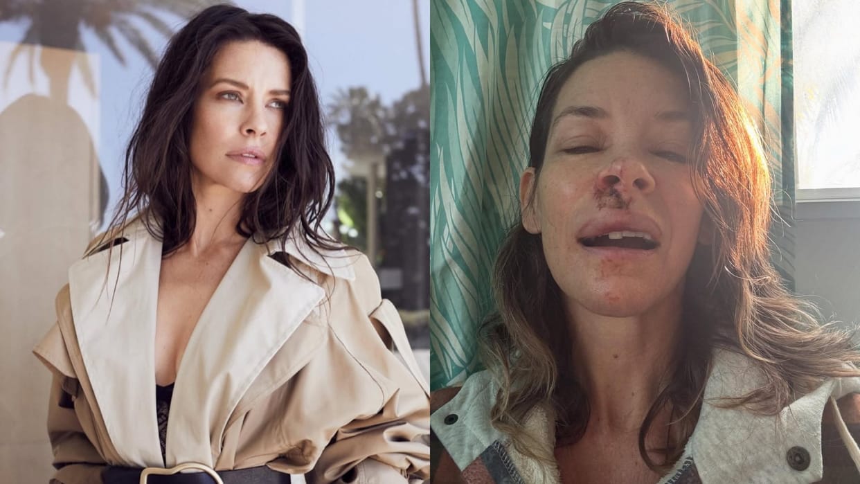 Evangeline Lilly shares pictures of her injuries and also tell the reason of getting injured