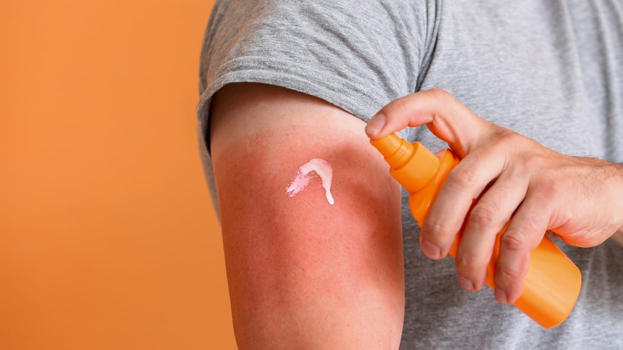 Home Remedies for Sunburned Hands Quick sunburn remedies for hands