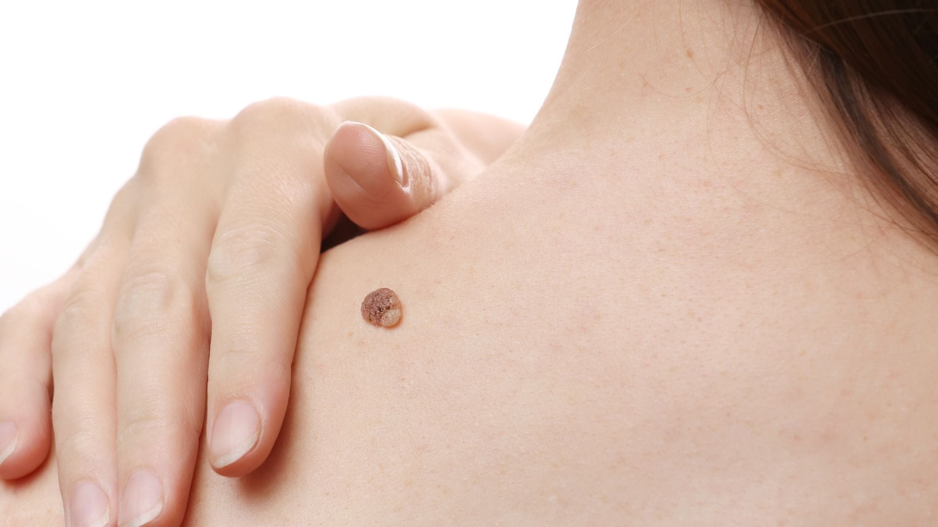 Warts on Body Causes Health Risks Sharir Par Masse Kyu Hote Hain in Hindi