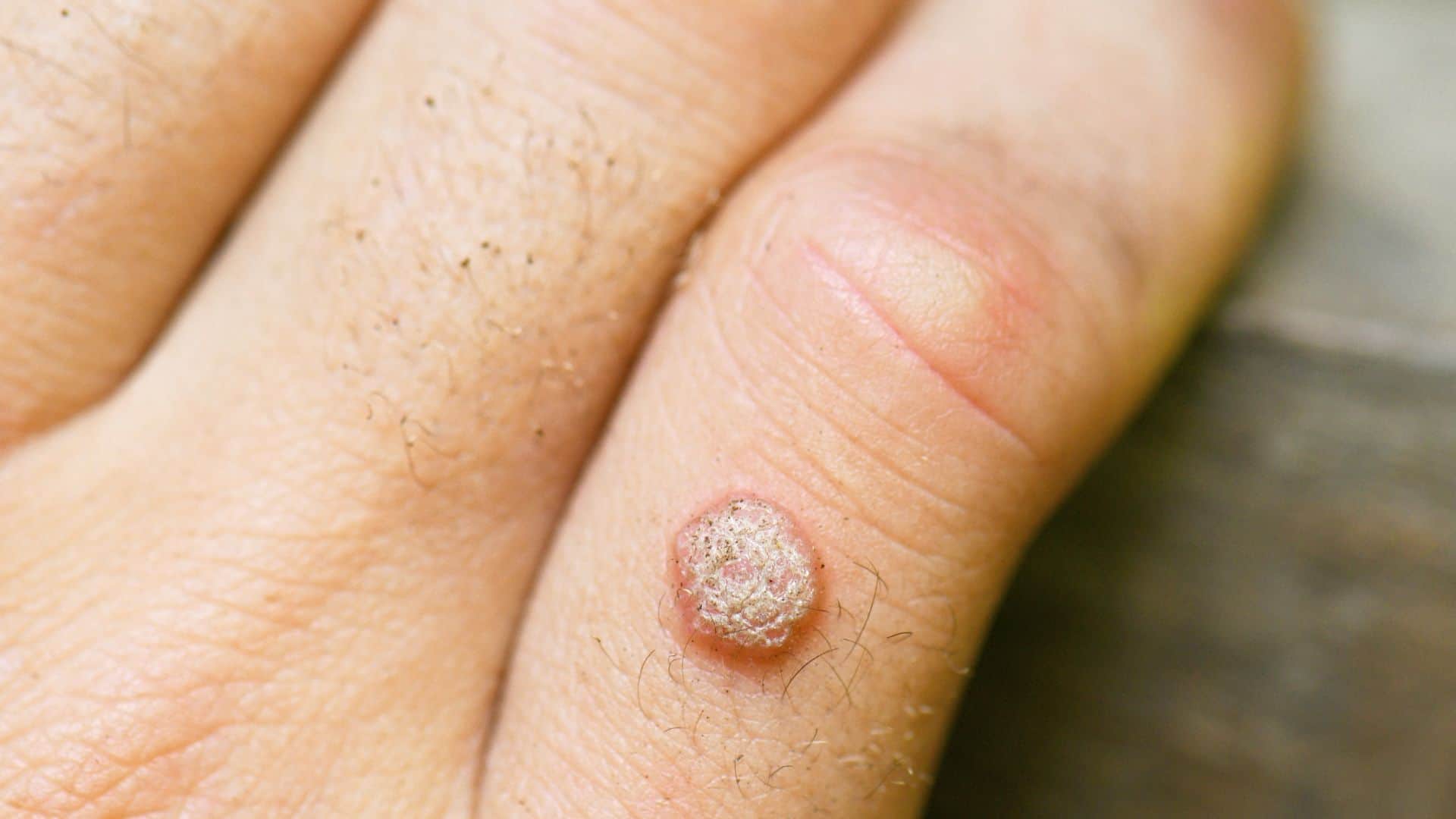 Why do we get warts on the body Know the reason behind it know in hindi