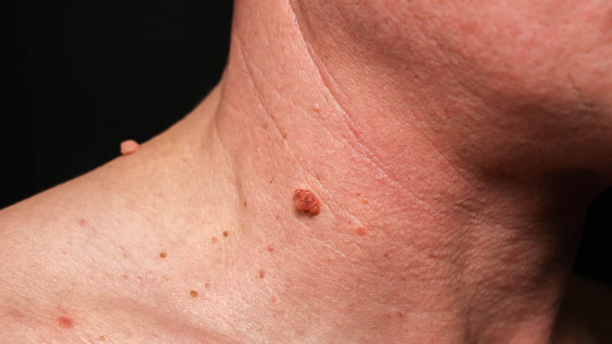 Why do we get warts on the body Know the reason behind it know in hindi
