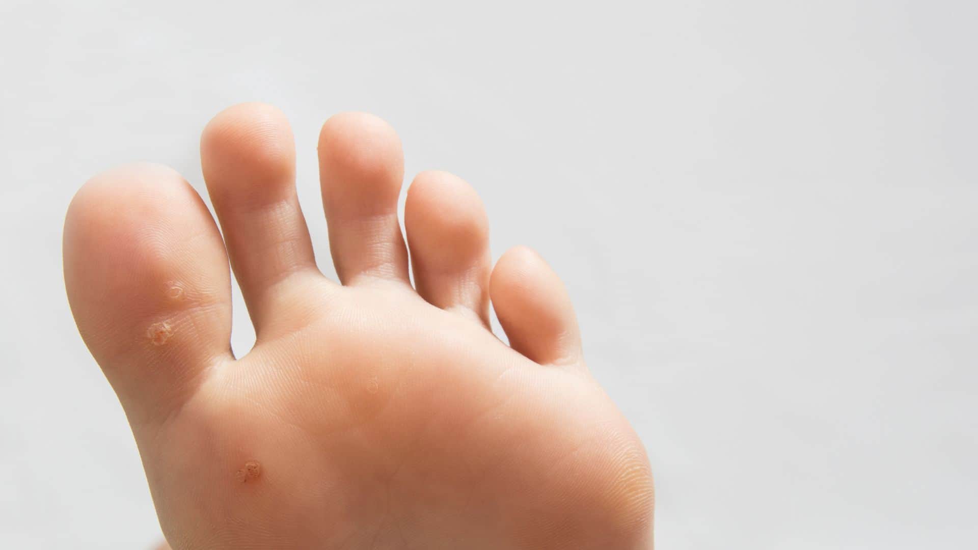 Why do we get warts on the body Know the reason behind it know in hindi