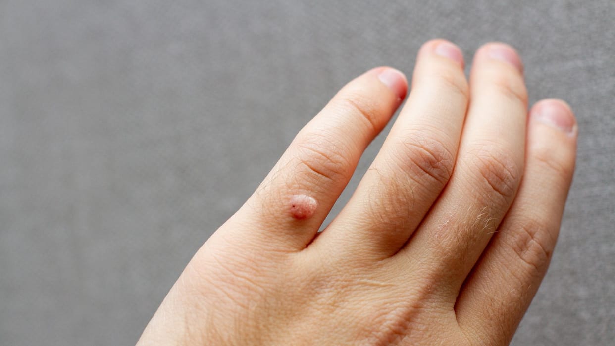 Warts on Body Causes Health Risks Sharir Par Masse Kyu Hote Hain in Hindi