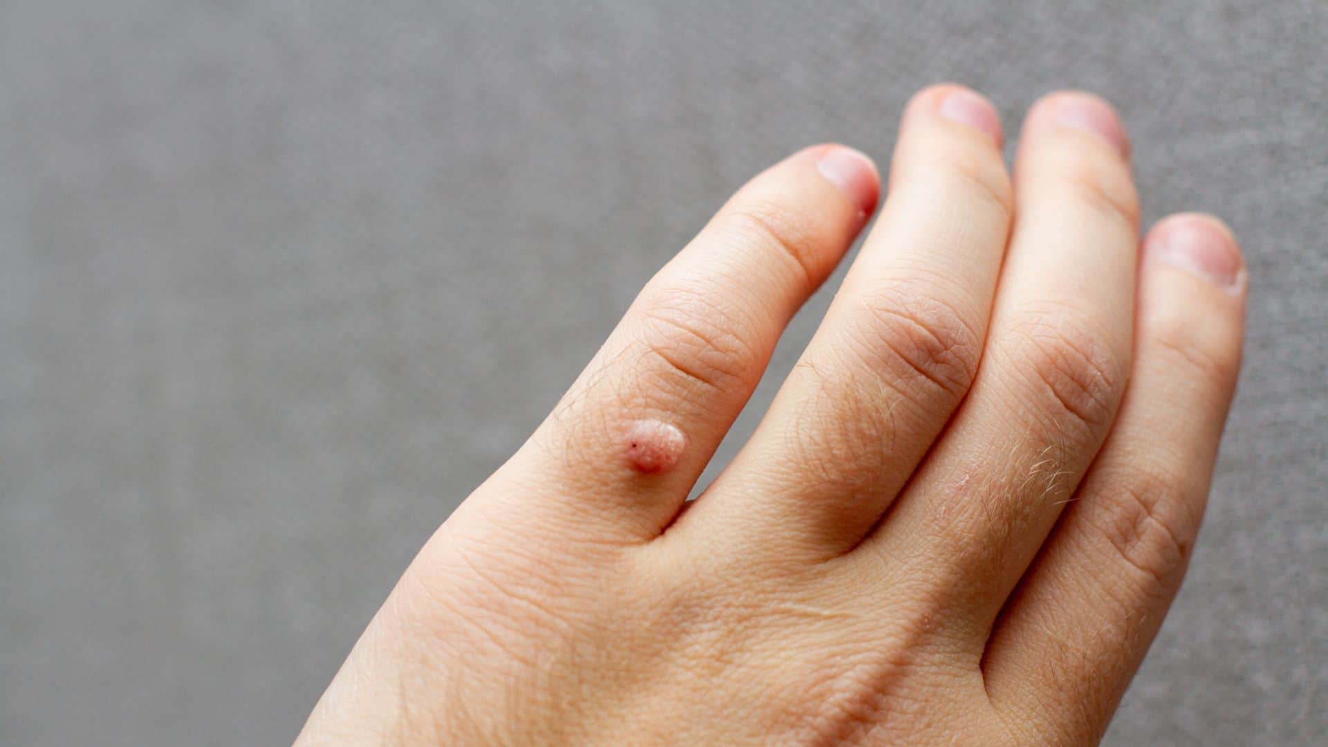 Why do we get warts on the body Know the reason behind it know in hindi