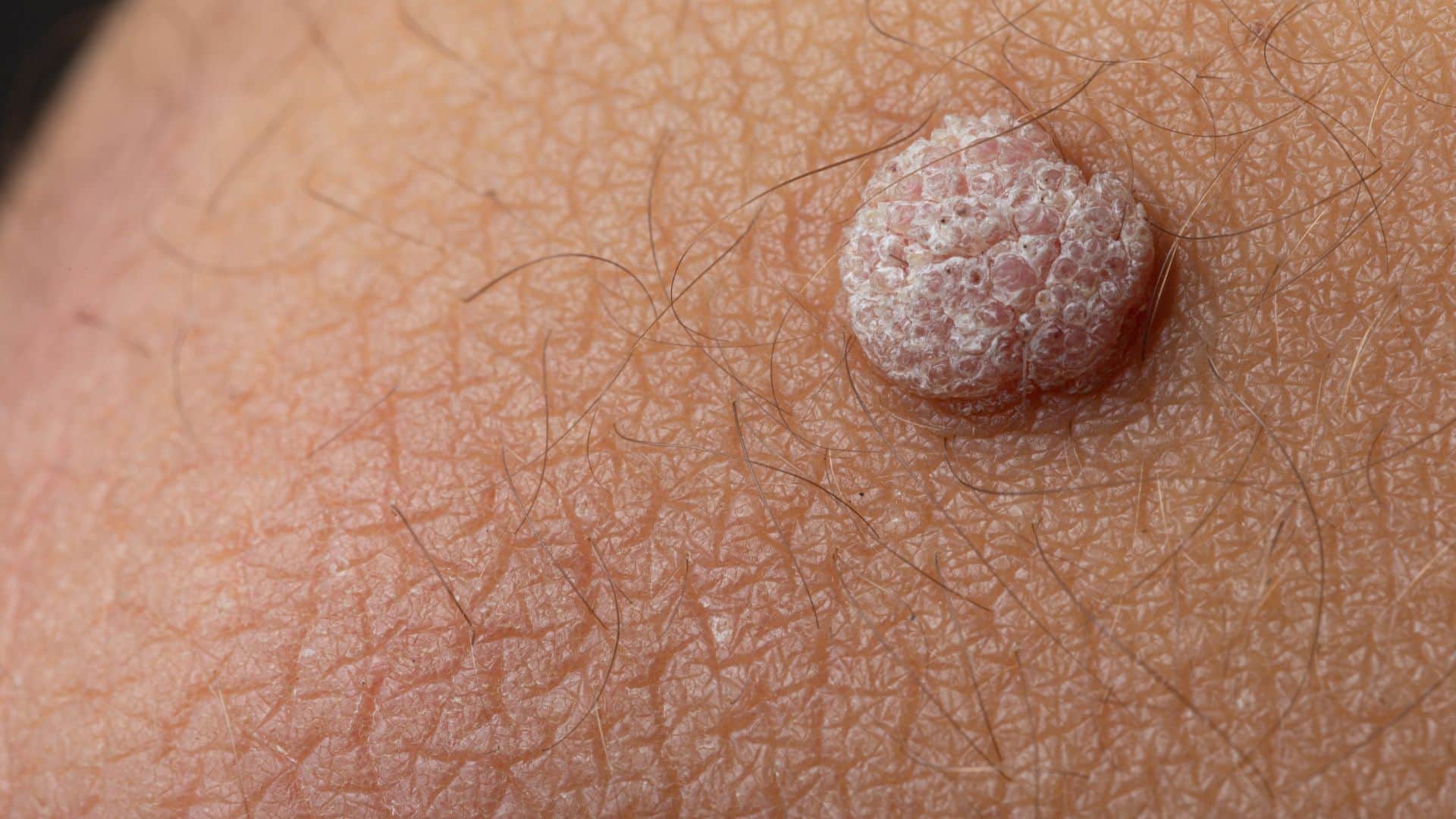 Why do we get warts on the body Know the reason behind it know in hindi