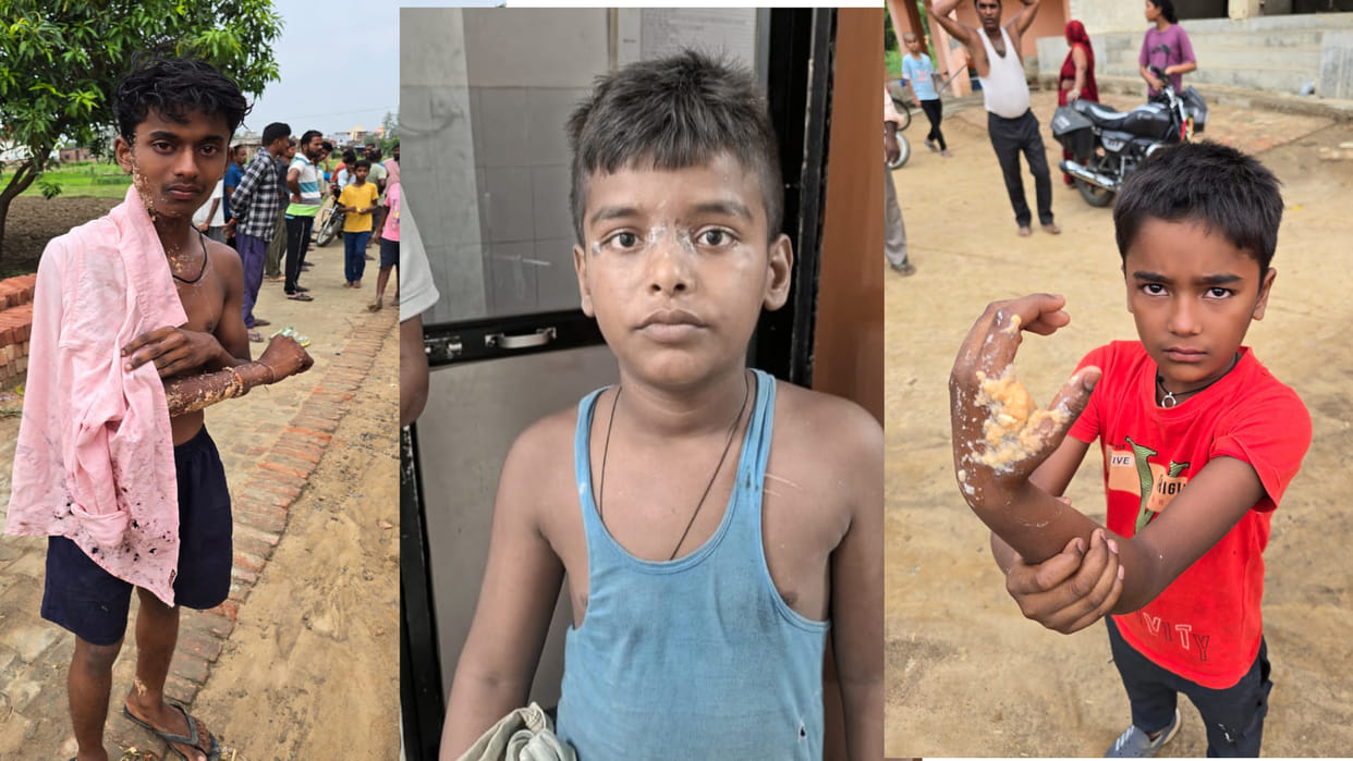 In Gorakhpur, a bullion trader threw acid on a debtor, two children along with a teenager got burnt