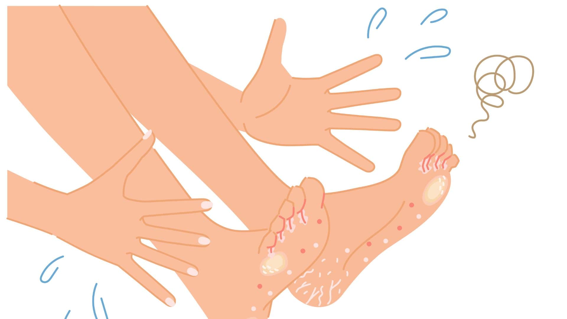 Foot Fungus in Summer Prevention Know 4 Skincare Tips Before Monsoon Rainy Season