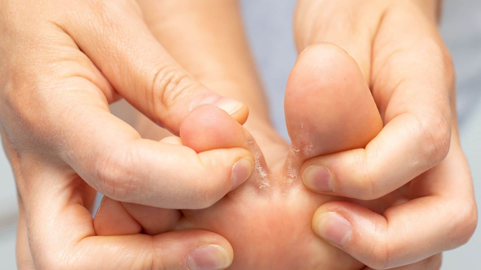 Foot Fungus in Summer Prevention Know 4 Skincare Tips Before Monsoon Rainy Season