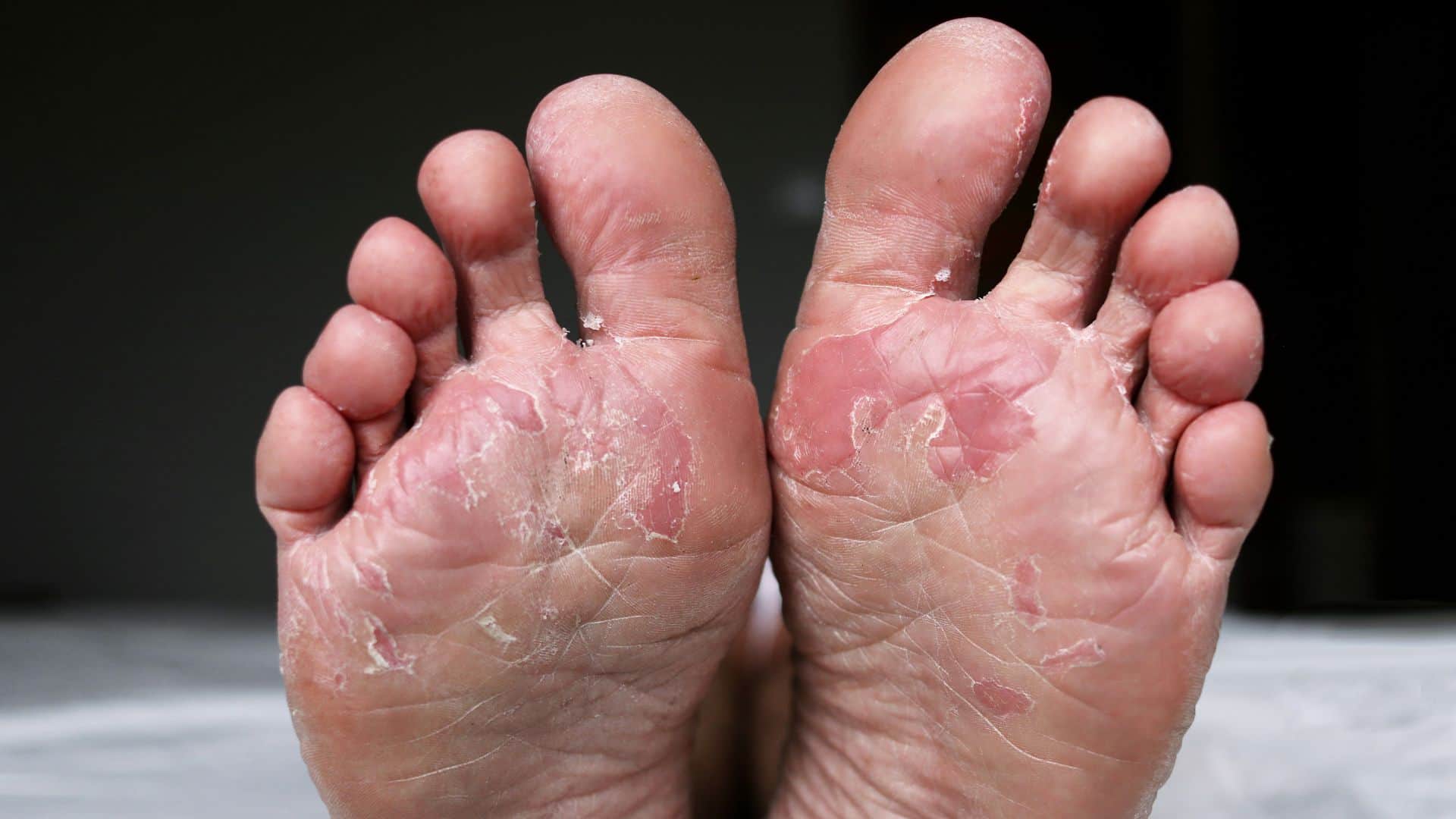 Foot Fungus in Summer Prevention Know 4 Skincare Tips Before Monsoon Rainy Season