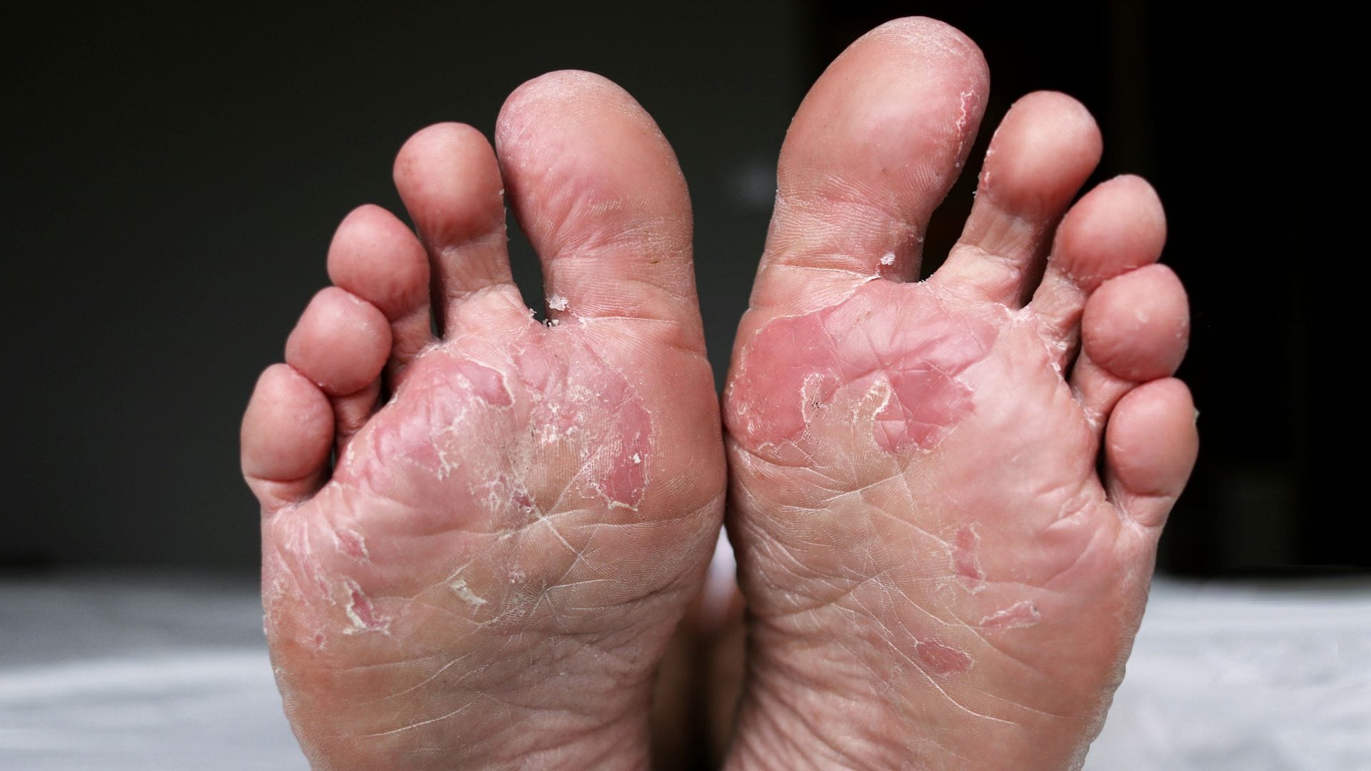 Foot Fungus in Summer Prevention Know 4 Skincare Tips Before Monsoon Rainy Season