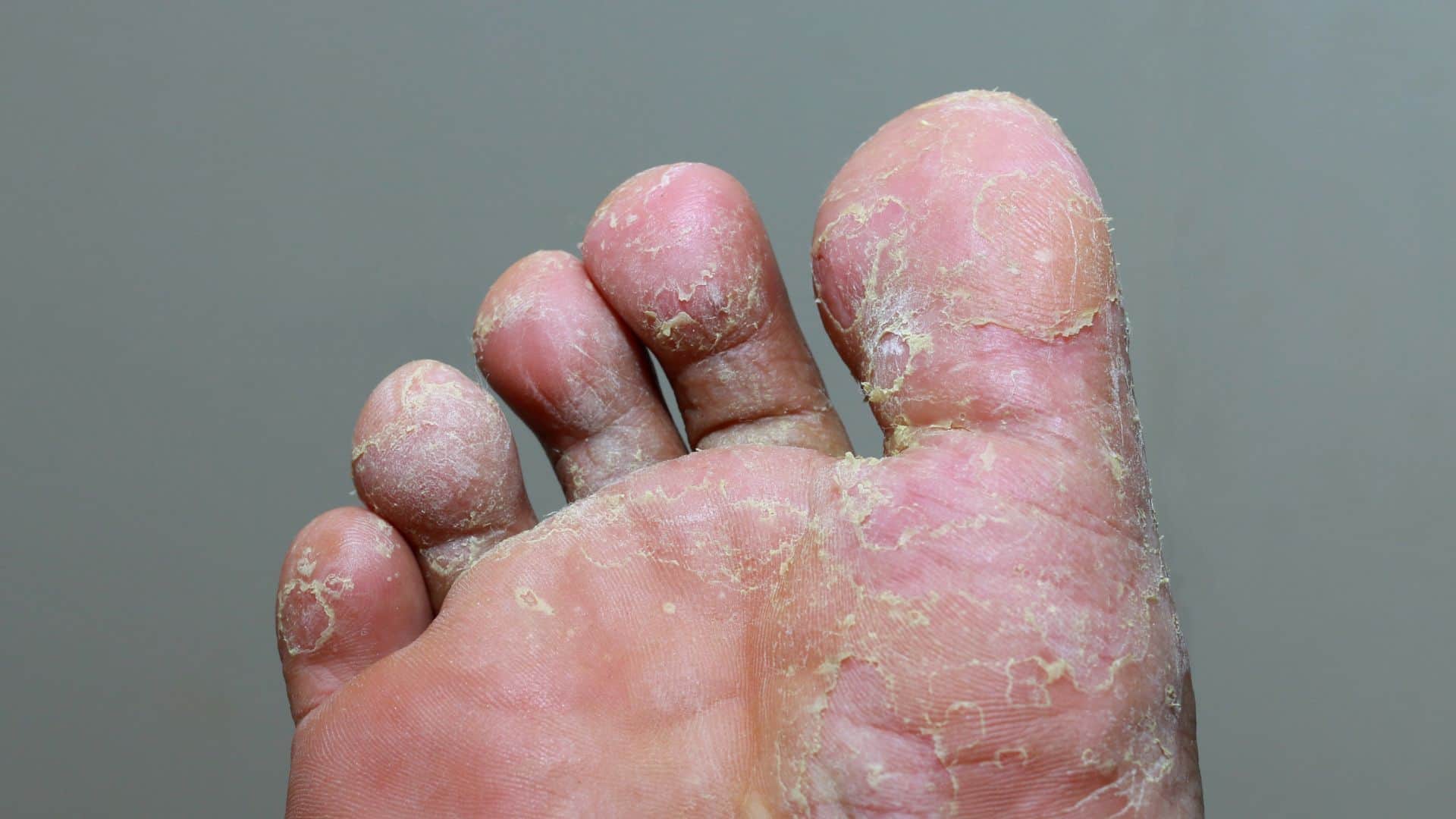Foot Fungus in Summer Prevention Know 4 Skincare Tips Before Monsoon Rainy Season