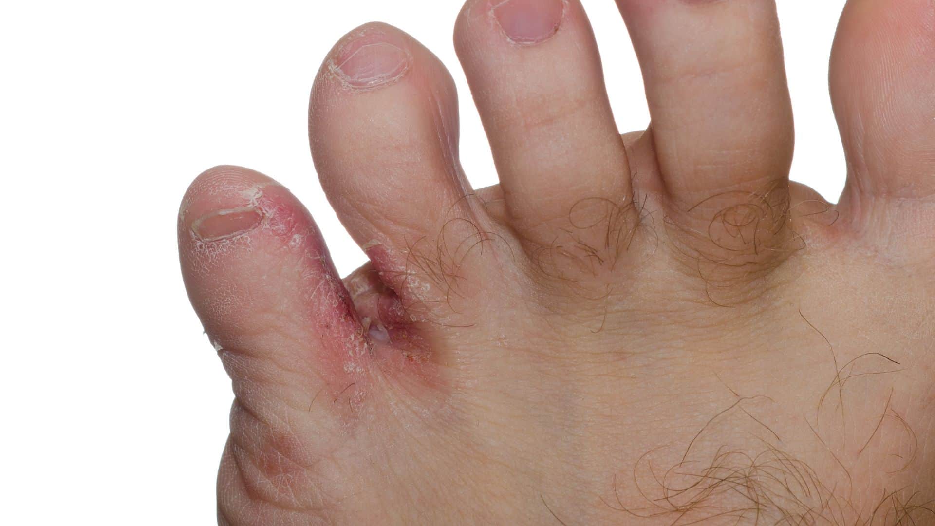 during monsoon risk of these diseases increases know how to prevent them in hindi