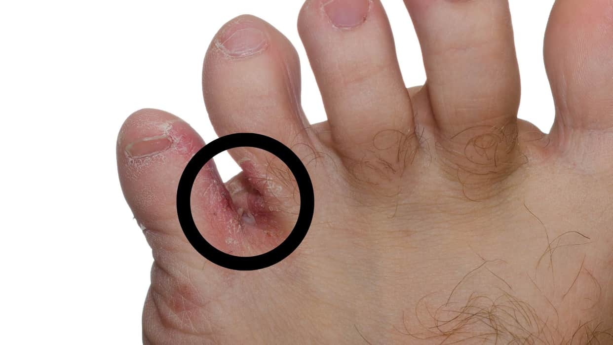 Foot Fungus in Summer Prevention Know 4 Skincare Tips Before Monsoon Rainy Season