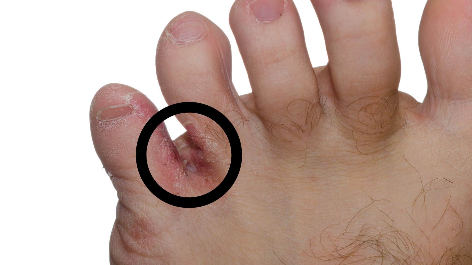 Monsoon Tips Take these precautions to avoid fungal infection during the rainy season