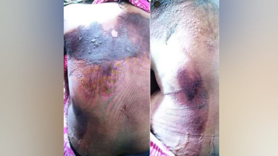 Negligence during C-section of about a dozen pregnant women in the MCH wing of Pilibhit Medical College
