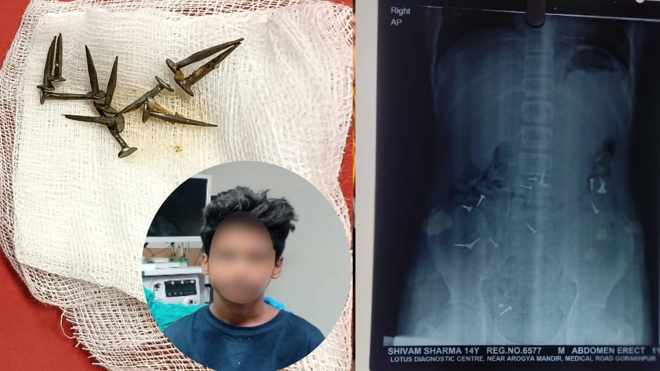 UP News 14 Year Old Swallows 17 Nails After Scolding by Father Saved After Emergency Surgery in hospital