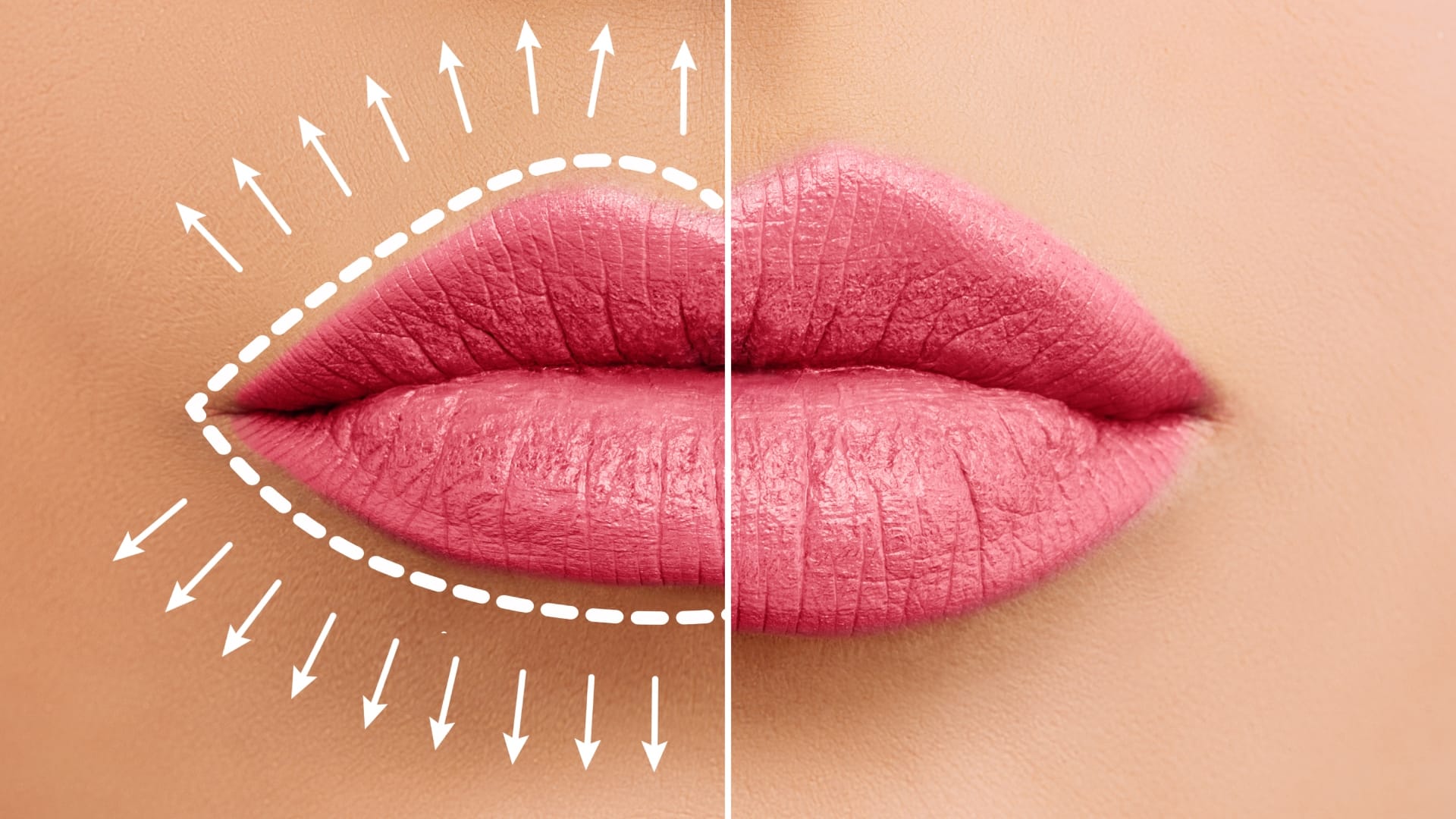 what is the reason behind uorfi javed lip swelling side effect of wrong lip fillers