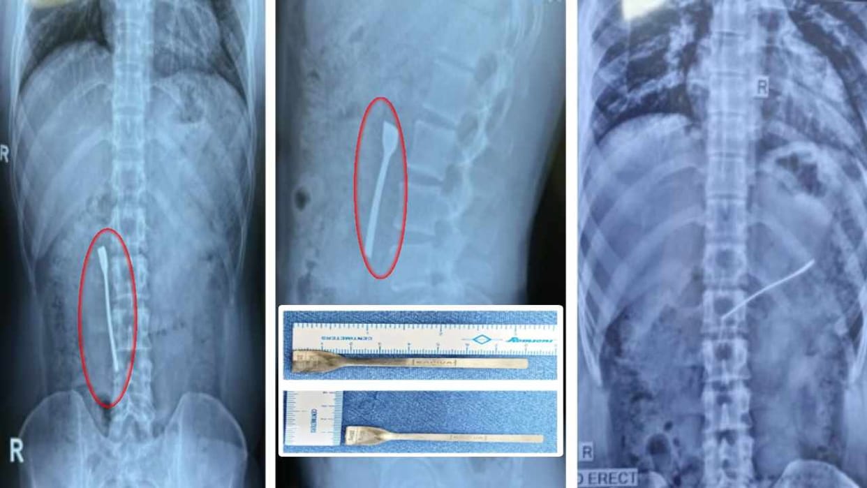 doctors remove spoon from stomach of patient in shalimar bagh