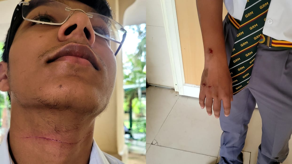Student injured by Chinese manjha on Qutubkhana bridge in Bareilly