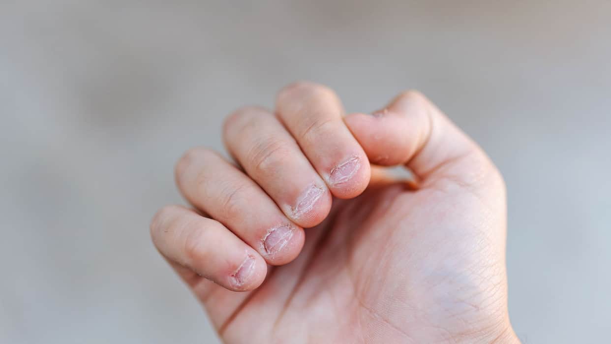 Nail Health Sign 4 Hidden Sign  in Nail Color and Texture Say About Your Health