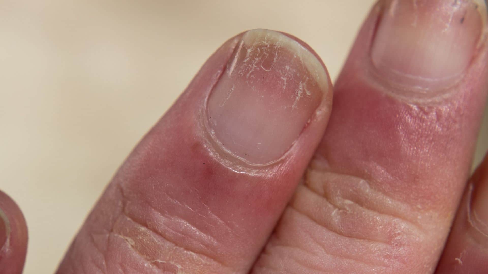 From Color to Shape Nail Changes Doctors Say May Signal Serious Diseases