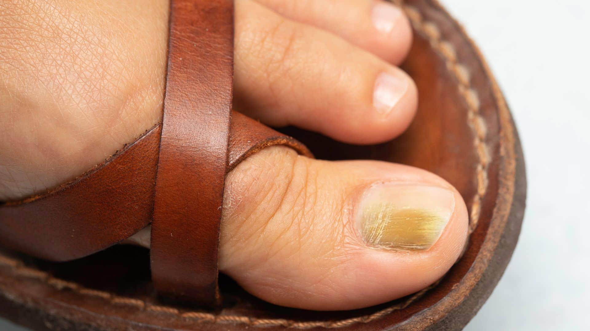 From Color to Shape Nail Changes Doctors Say May Signal Serious Diseases