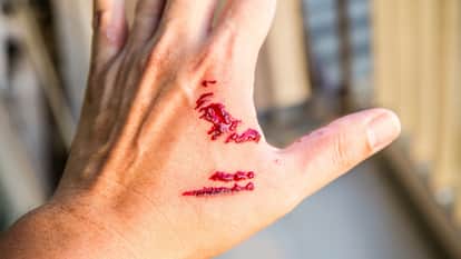 Dog Bite Case Three months after bitten young man having dangerous symptoms of rabies condition is critical