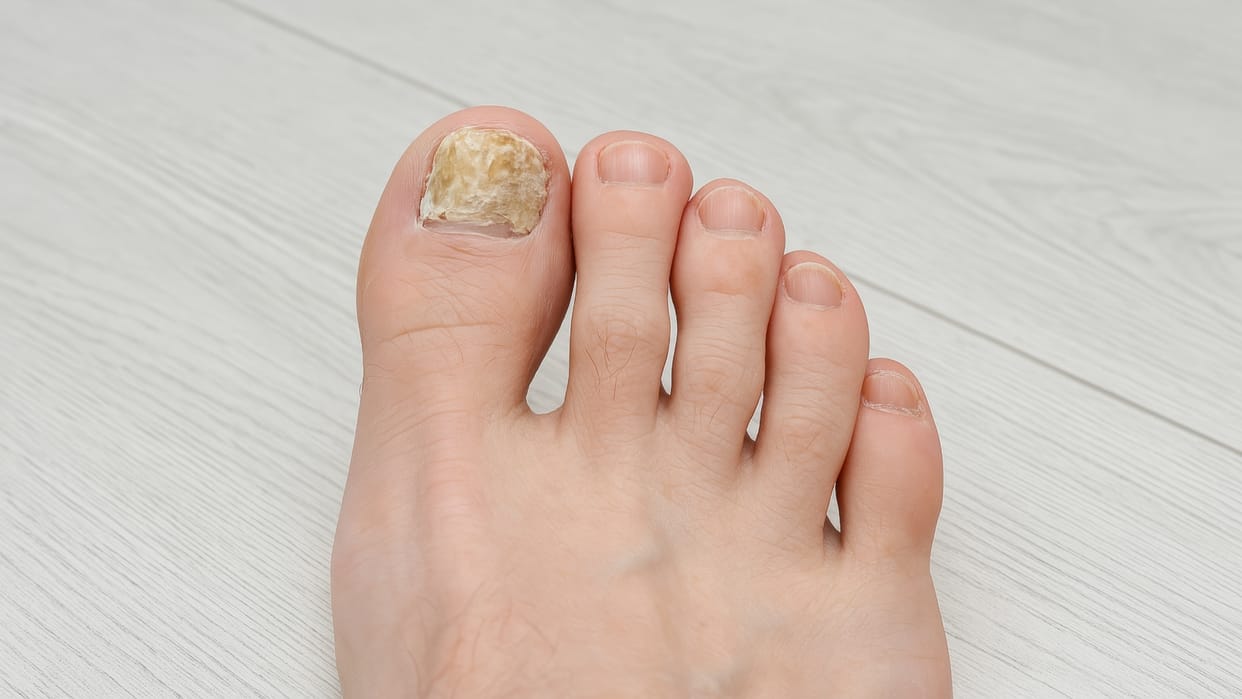 How to Protect Nails from Fungal Infections During Rainy Season