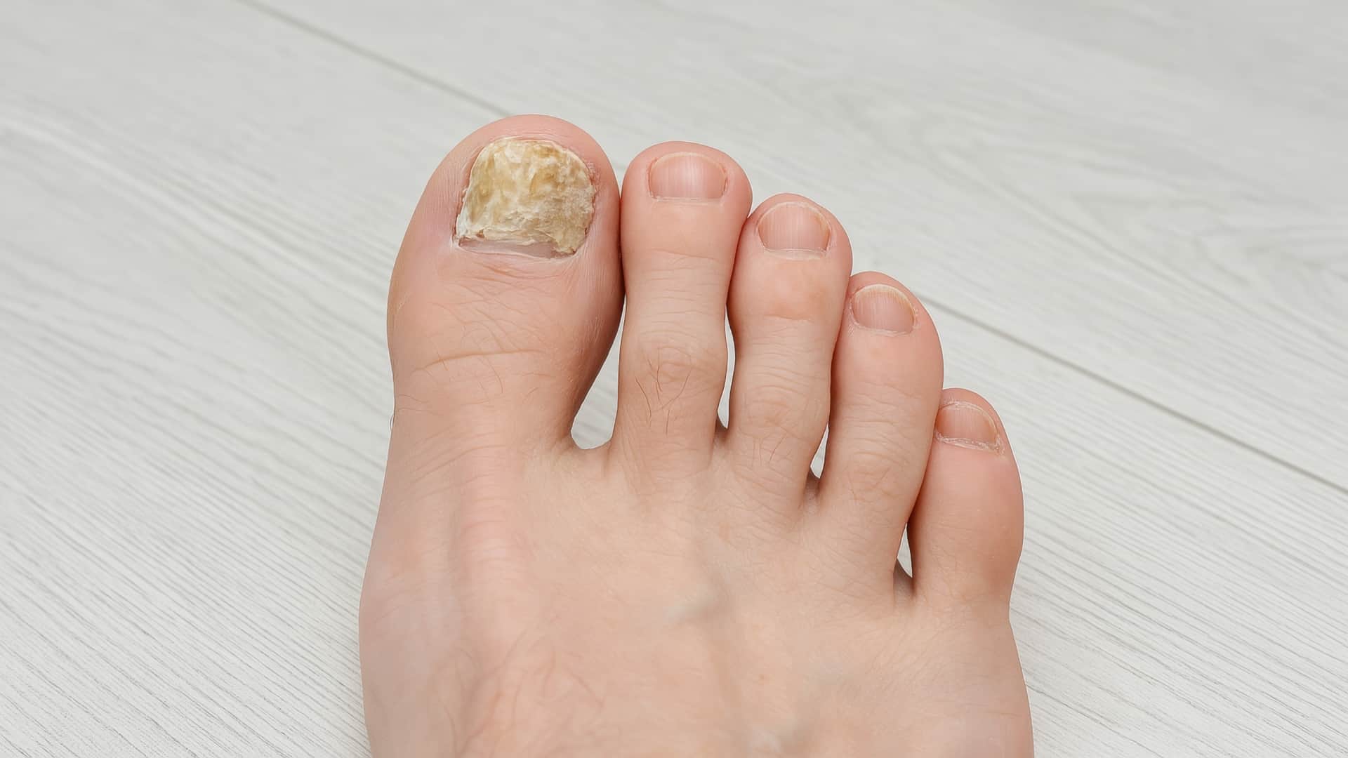 Brittle nails causes know What deficiency or diseases causes breaking of nails?