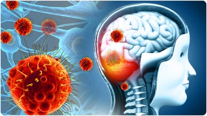 Russian scientists developed device for treatment of glioblastoma new hope for patients
