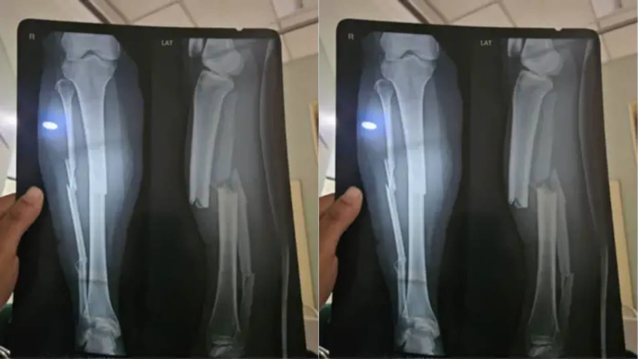 A woman met with an accident due to the cab drivers mistake company immediately withdrew with bills