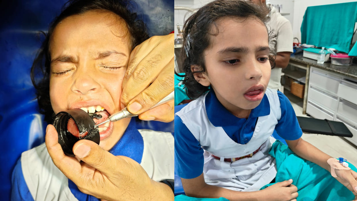 A bottle cap got stuck in the tongue of a school girl in Gorakhpur's Gorakhnath police station area