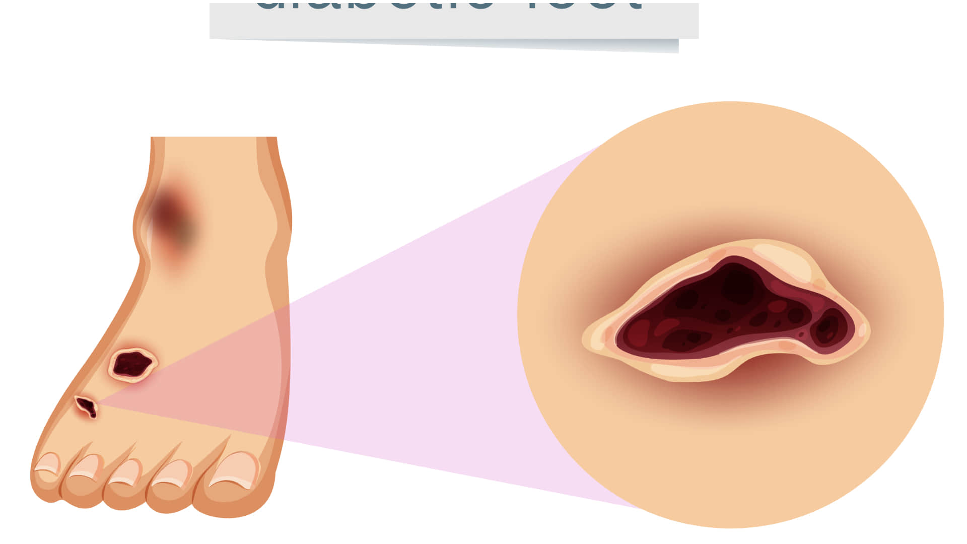 Health Tips Why Do Wounds Heal Slowly In Diabetes Know Reason Behind Slow Healing
