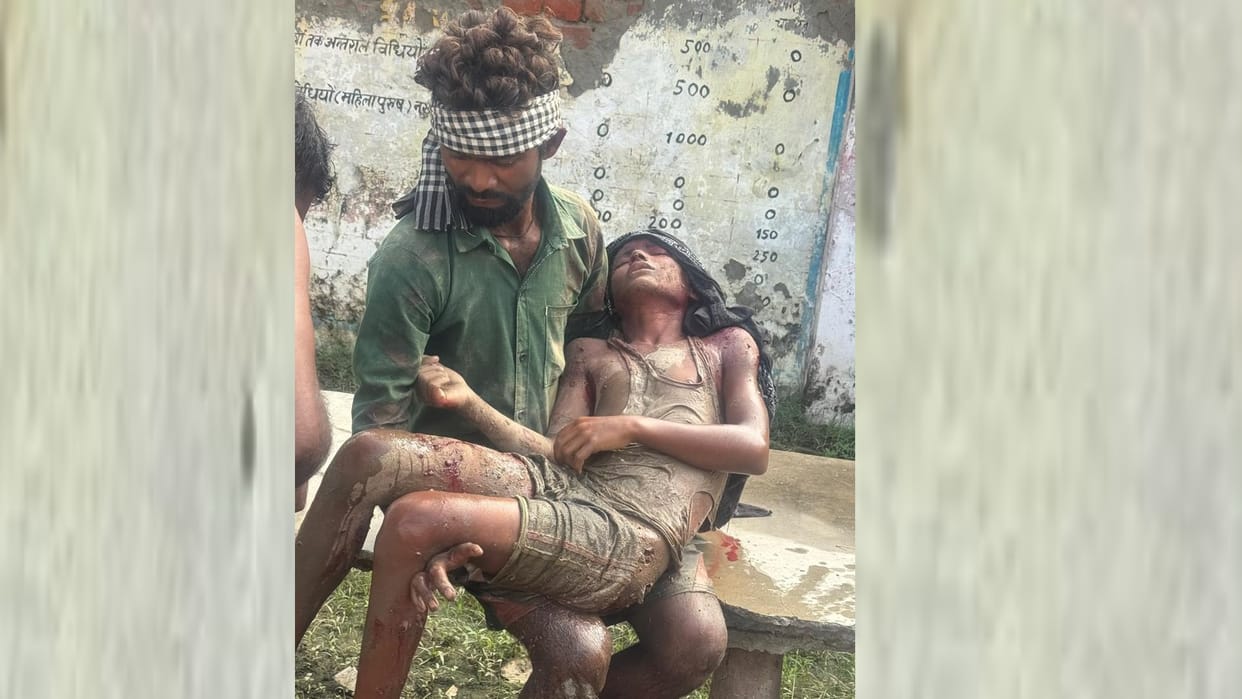 UP: A pack of dogs chewed the thigh and head of a teenager, referred to Lucknow