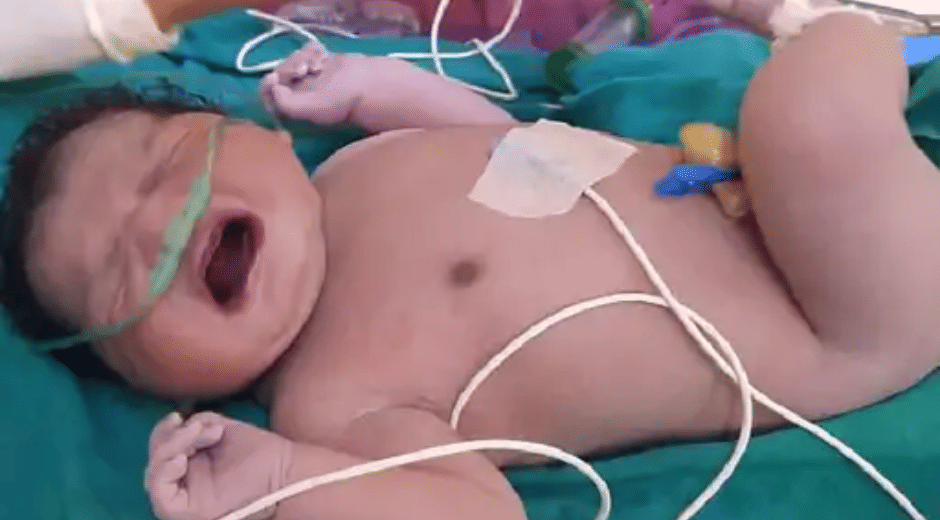 Indore News: 5.43 kg baby girl sets new weight record in government hospital