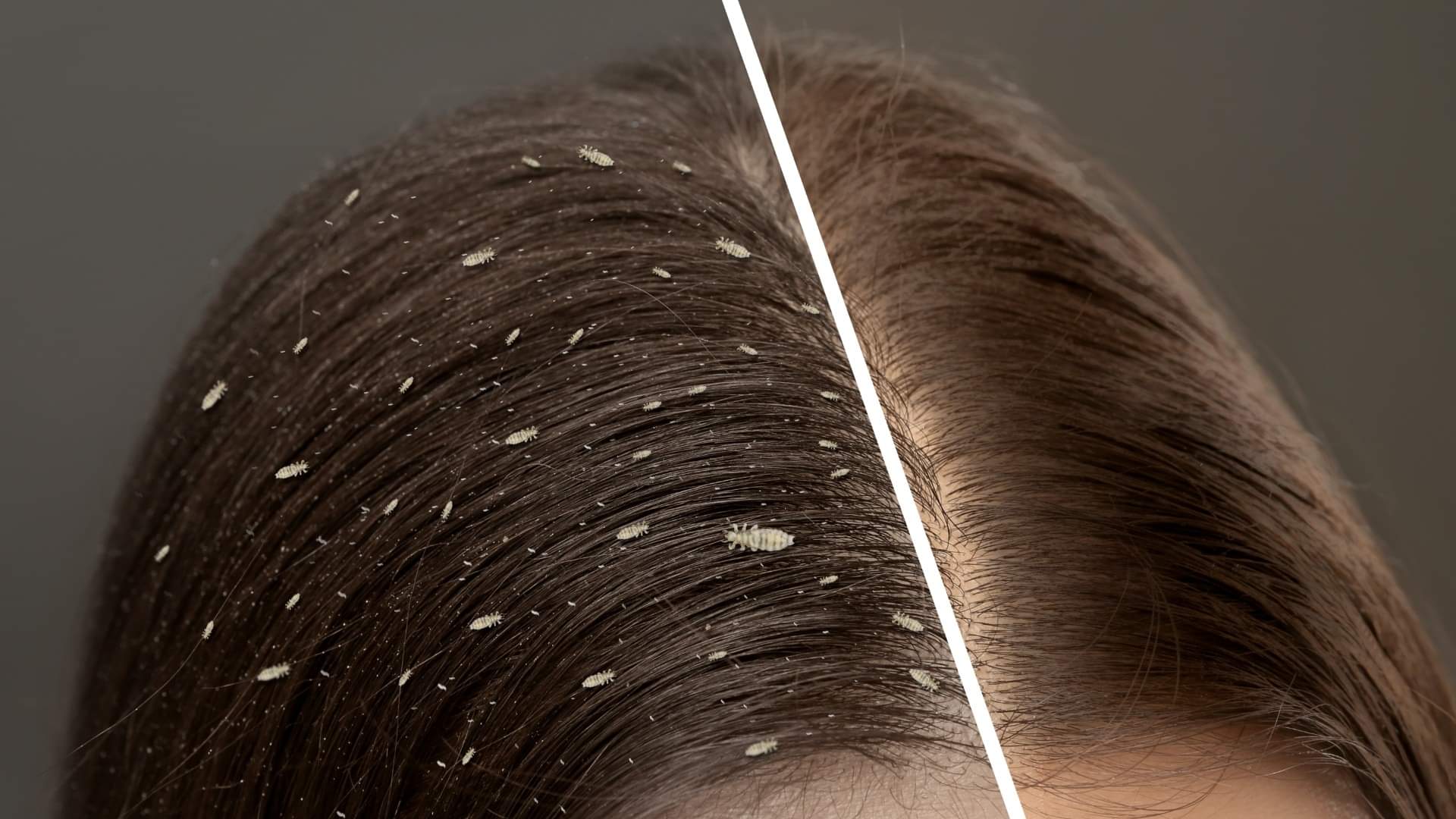 Hair Care Myths and Facts Can Rainwater Really Cause Head Lice